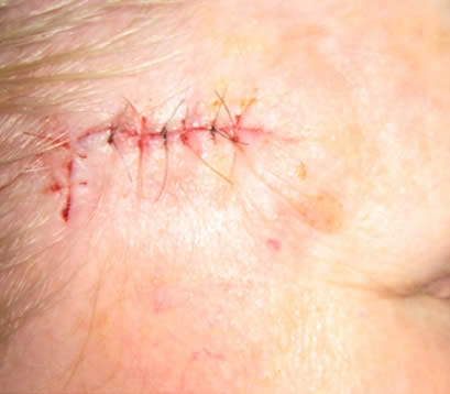 Closeup of closed wound on forehead after Mohs surgery