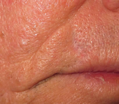 Fully healed close up upper lip after Mohs surgery