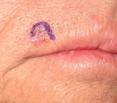 Closeup of skin cancer on upper lip of older male before Mohs surgery