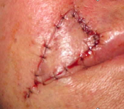 Closeup of closed wound on upper lip after Mohs surgery