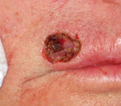 Closeup of open wound on upper lip of older male after Mohs surgery