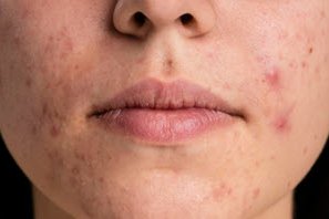 Severe acne on young woman's face